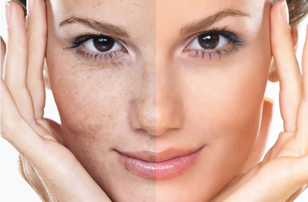 What is Hyperpigmentation Treatment?
