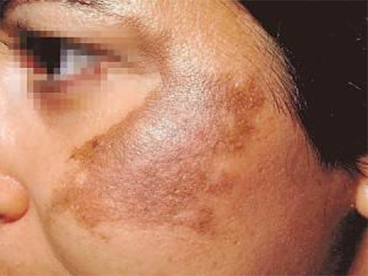 Hyperpigmentation