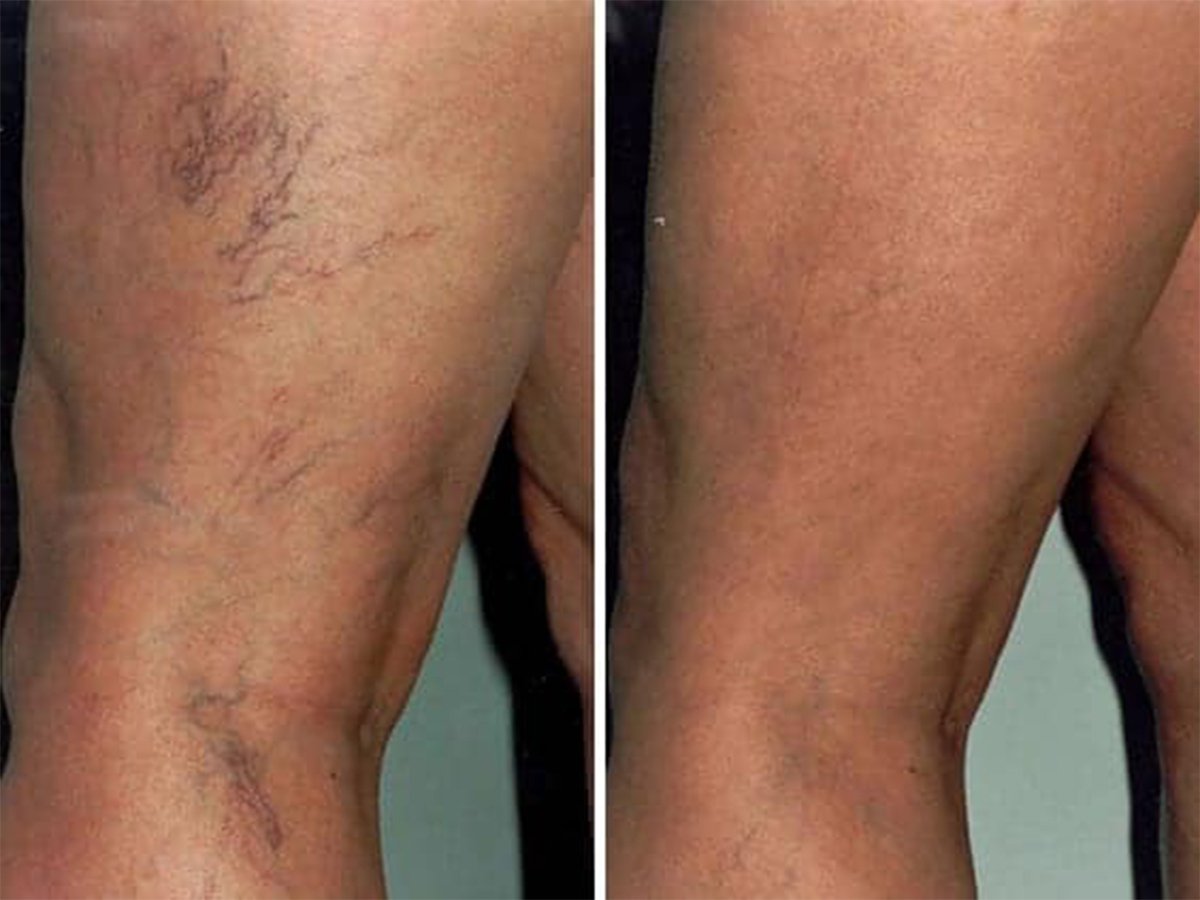 Sclerotherapy