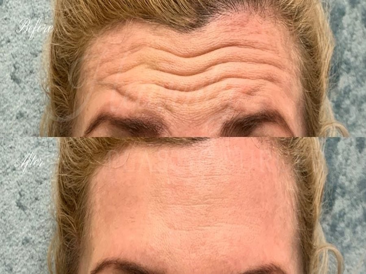 Botox Treatment