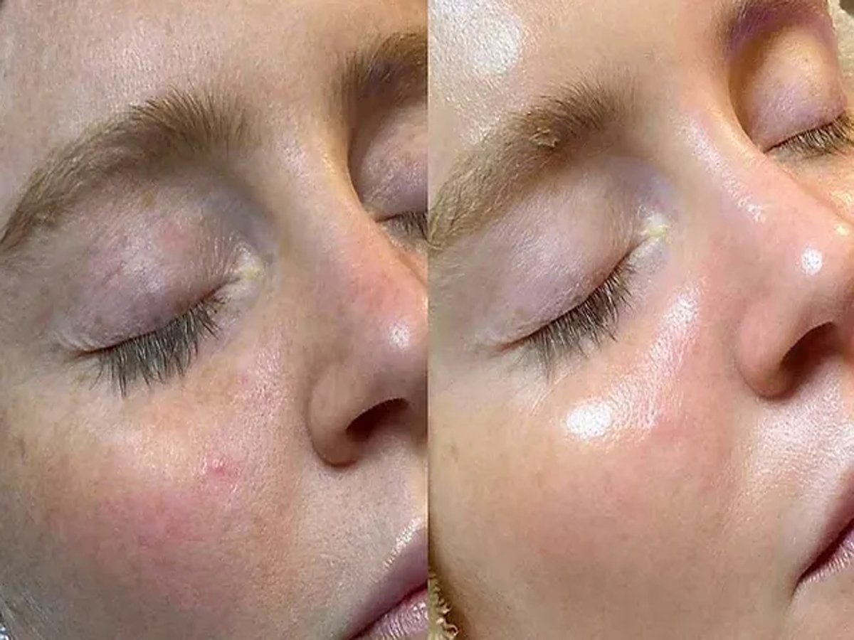PRP Hair Restoration