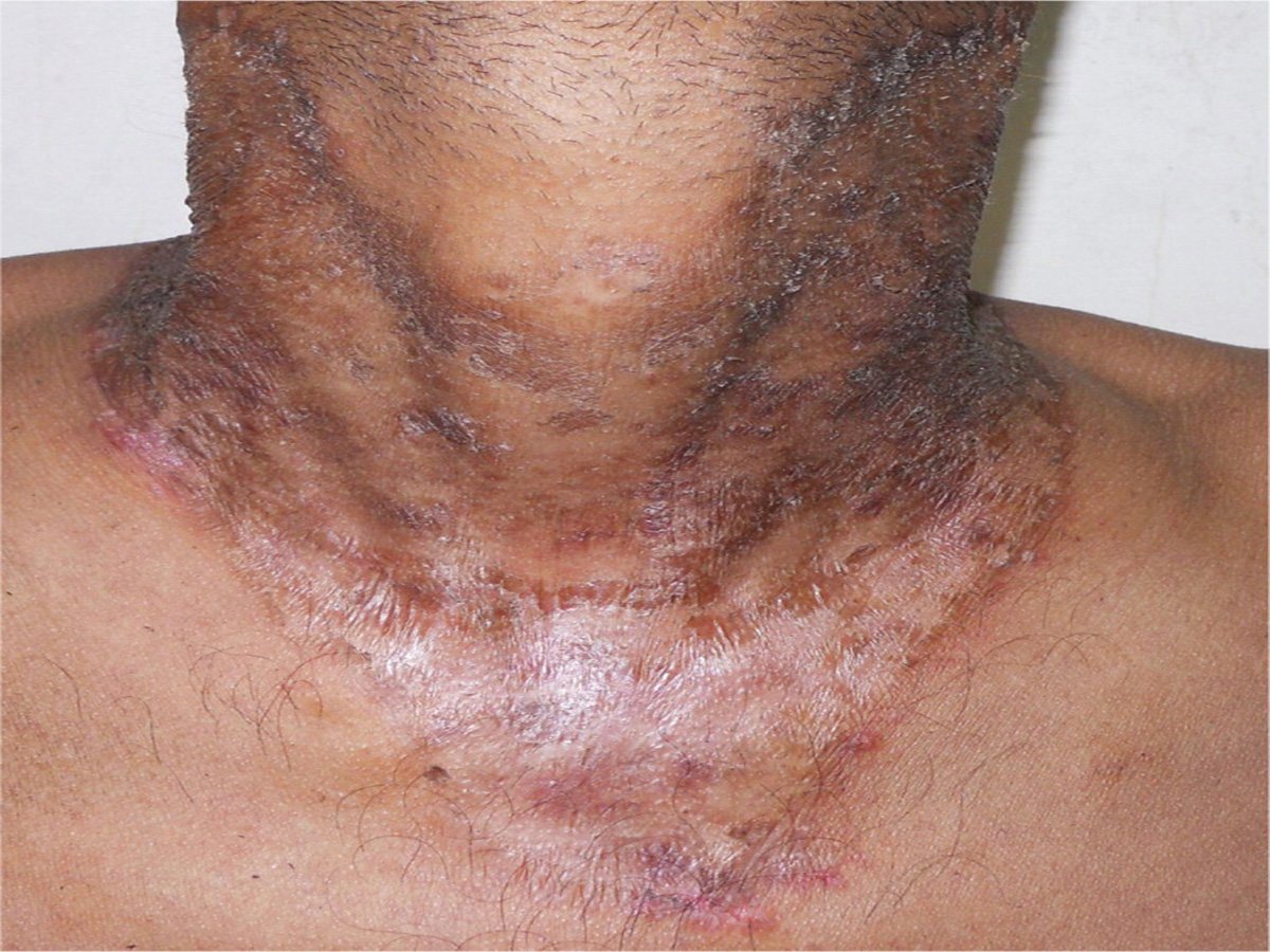PRP Hair Restoration
