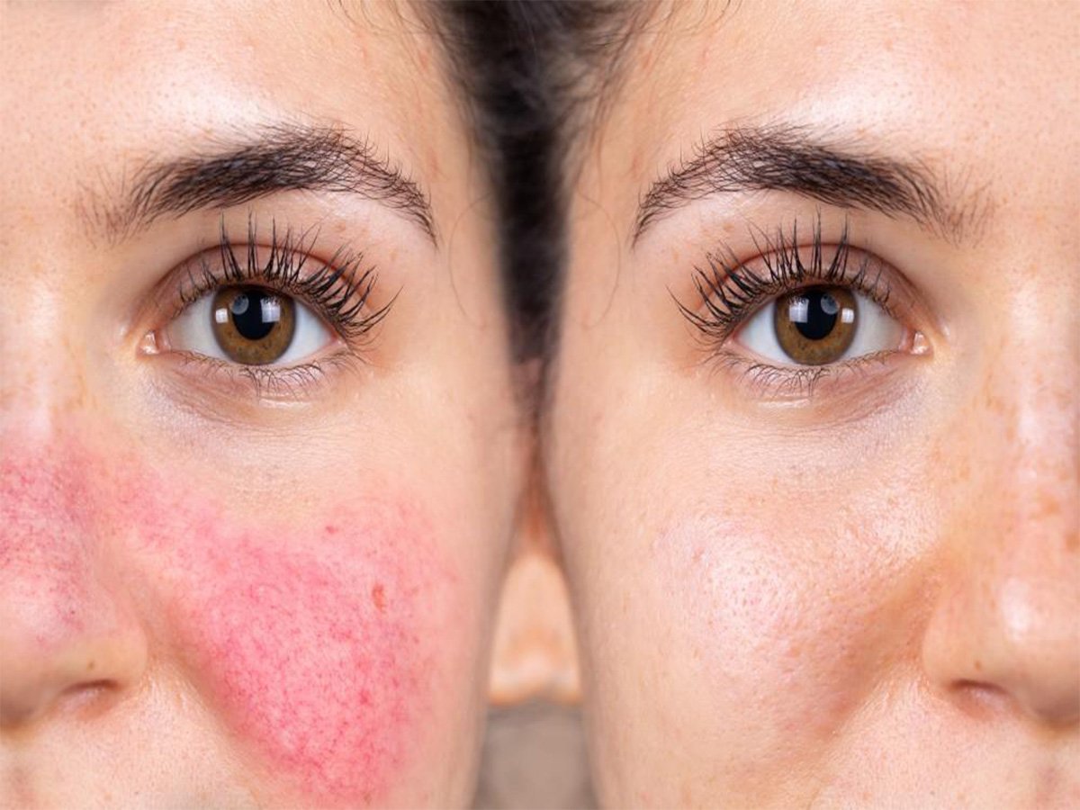 Rosacea Treatment