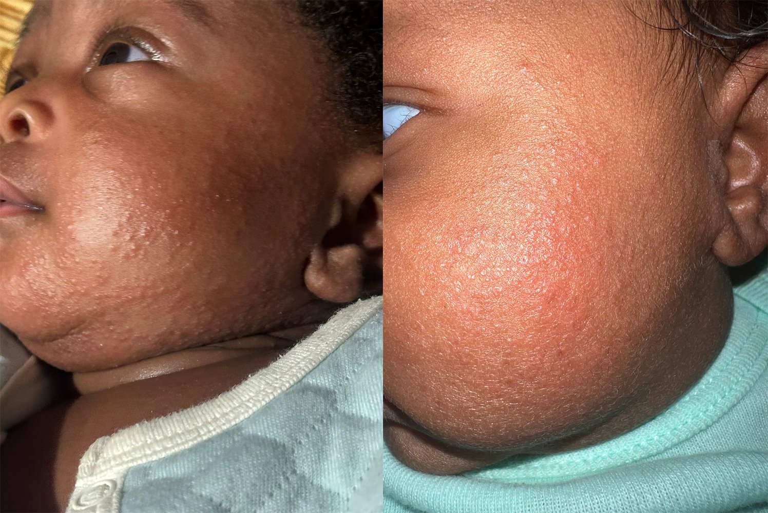 Child Skin Rash
