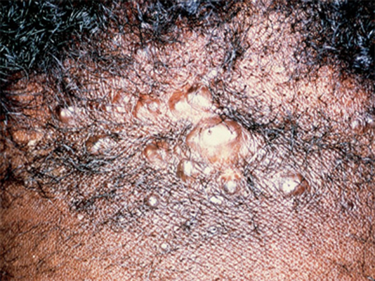 Hair Disorders