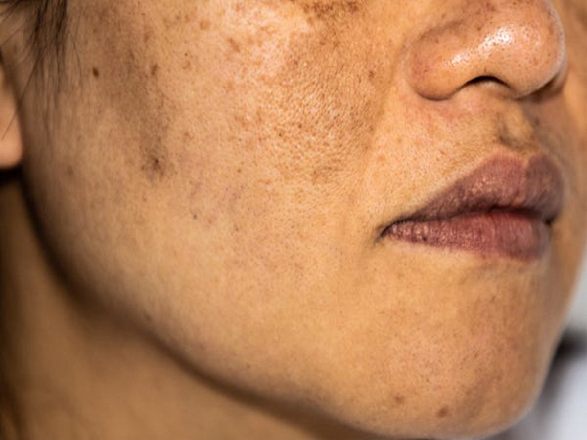 PRP Hair Restoration