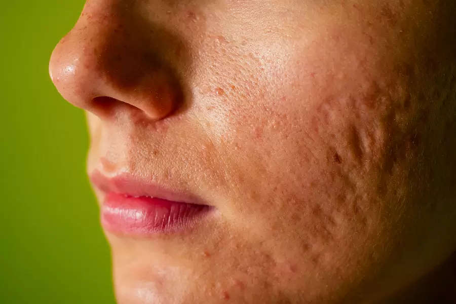 Scars Resurfacing