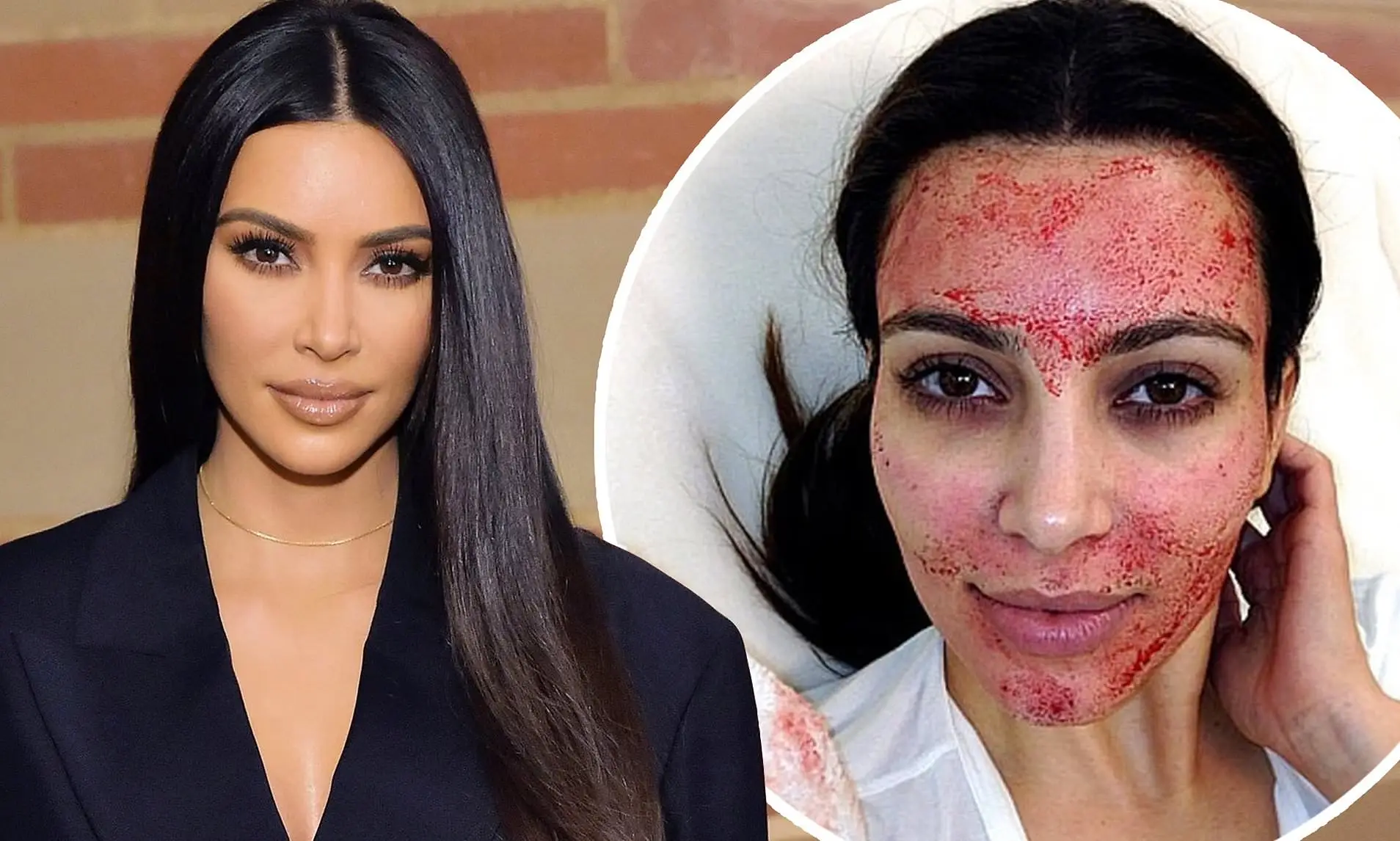 Vampire Face Lift